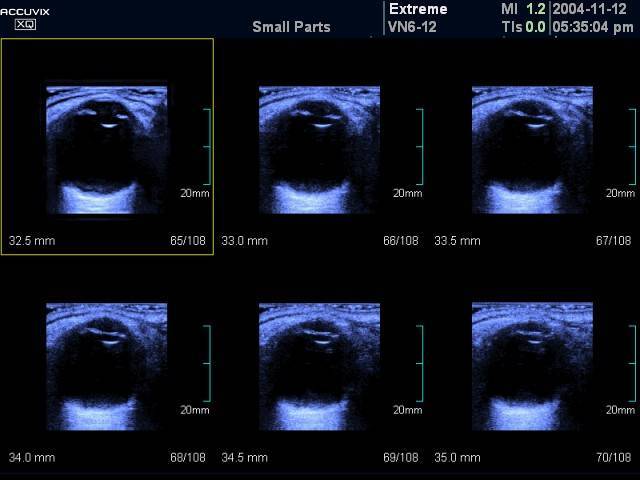 УЗИ глазного яблока